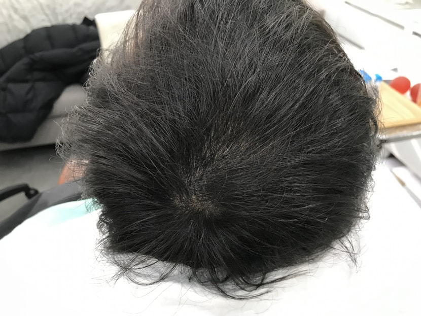 두달후 리터치 하기전