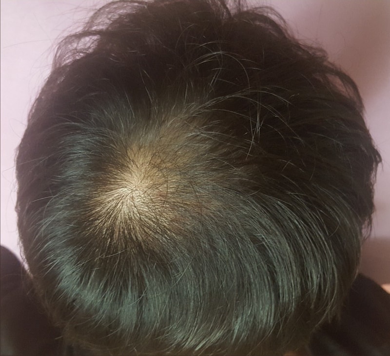头顶&发际线1次头皮纹身