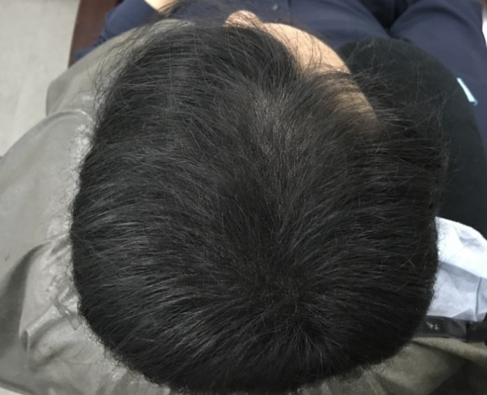 정수리전두부 시술후