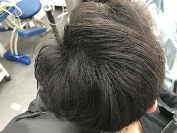 리터치 후