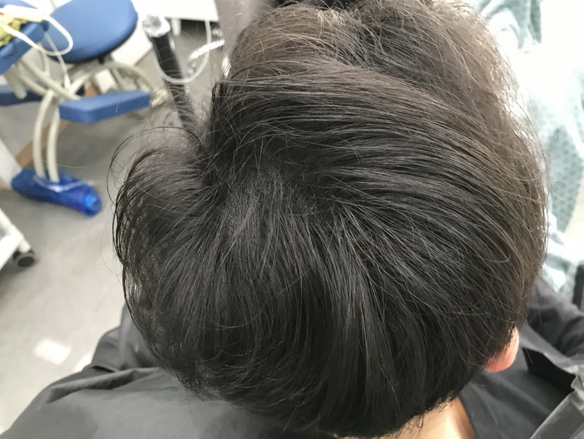 리터치 후