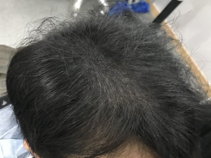 앞쪽 시술후