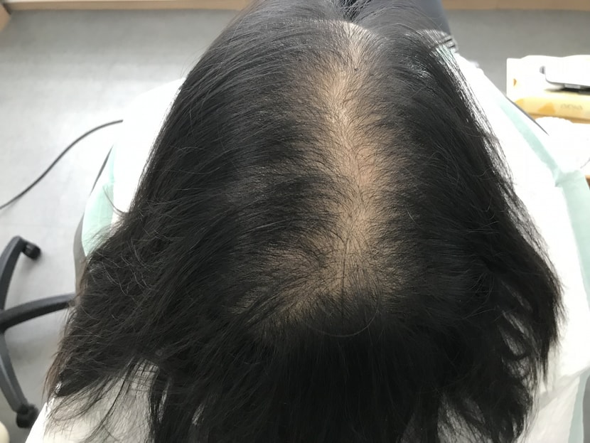 시술전 마른상태