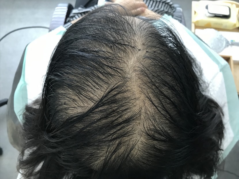 시술전 젖은상태