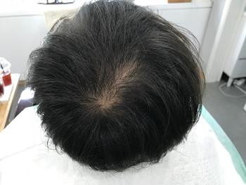 정수리 시술전