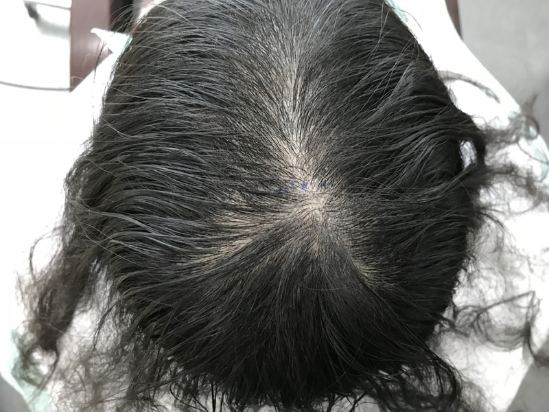 女子头顶头皮纹身后期^0^