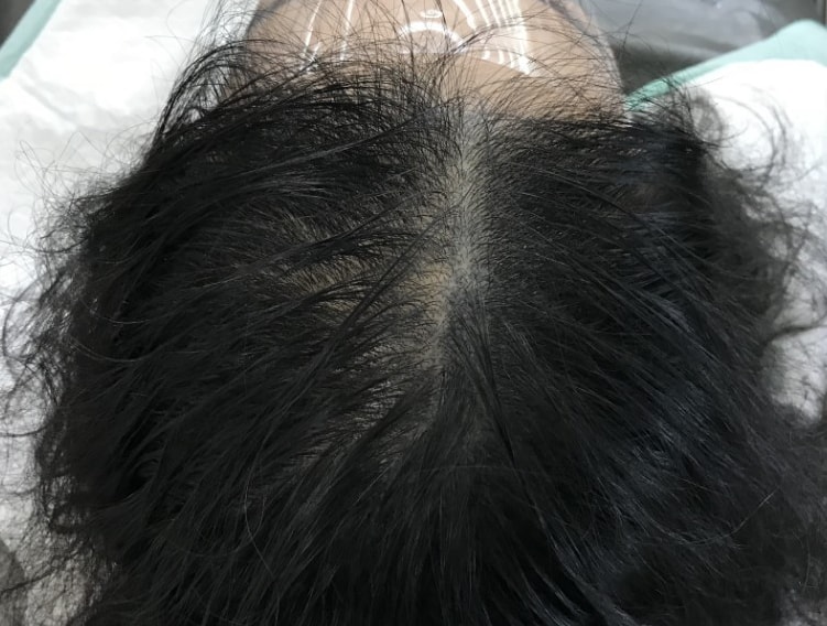 시술전