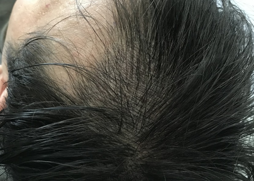 헤어라인자세히 후