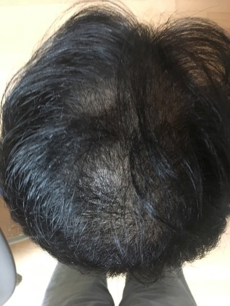 脱发进行得很宽广.. 终于纹头皮了。