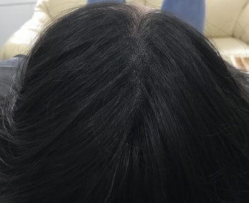 가르마 시술후