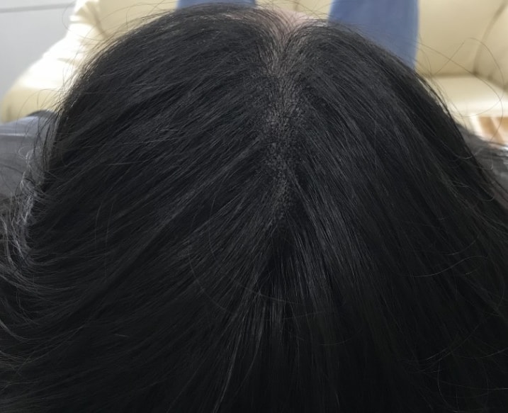 가르마 시술후
