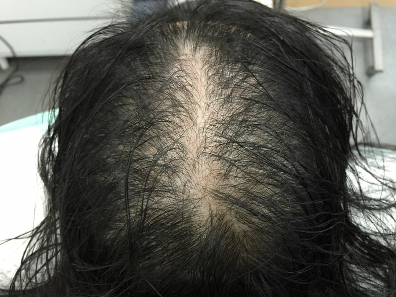 真的好久没来了。 头皮纹身8个月后