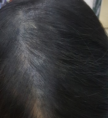 1차시술하고 한달후 집에서