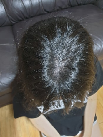 리터치 일주일후