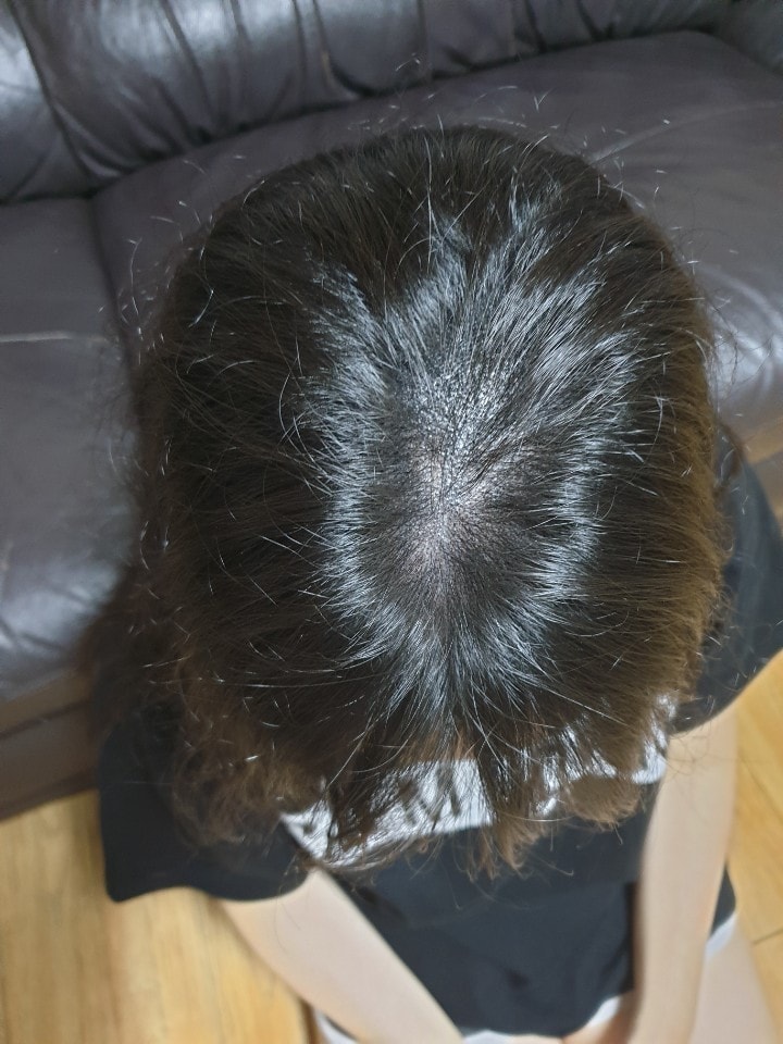 리터치 일주일후