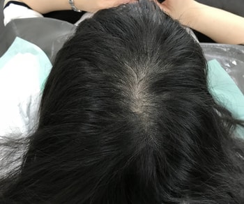 2차 시술전(1차 두달후)