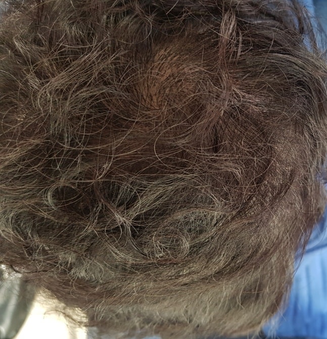 3주후 각질다떨어지고