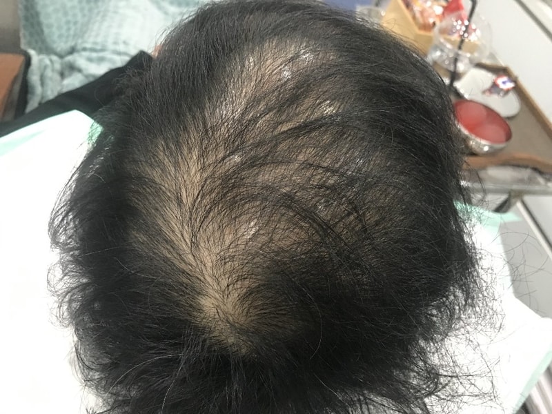 头皮纹身已经11个月了（手术前~最近）