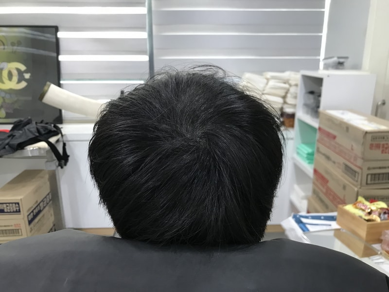 头皮纹身修复后记
