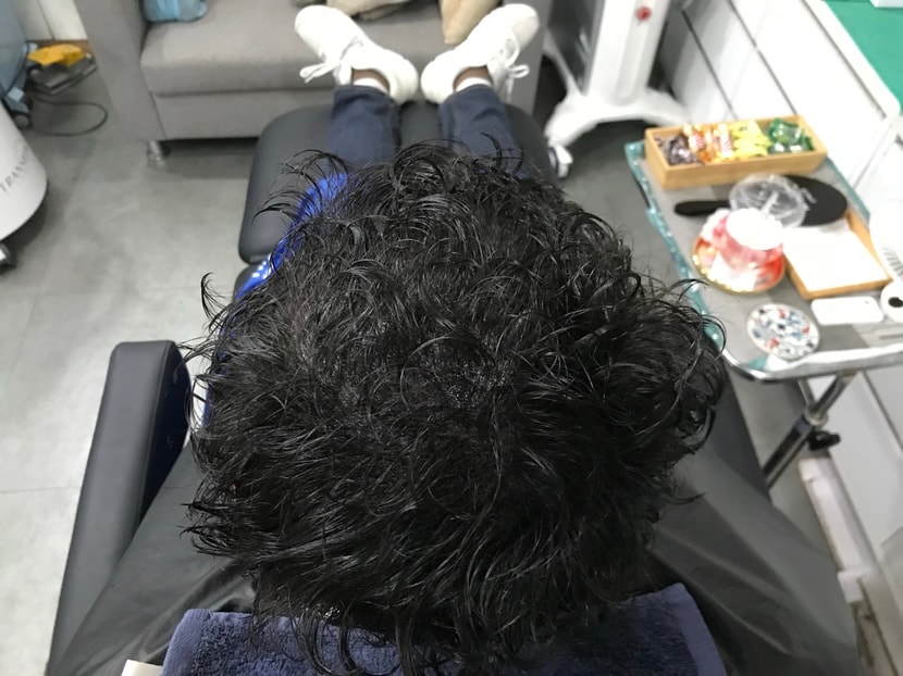 시술후