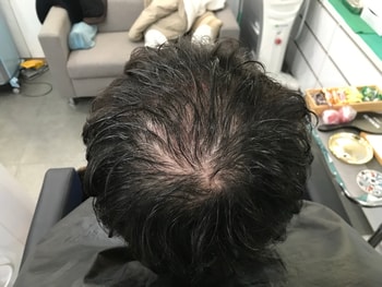 시술전