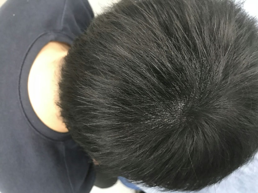 시술후 사진입니다 ㅎ 