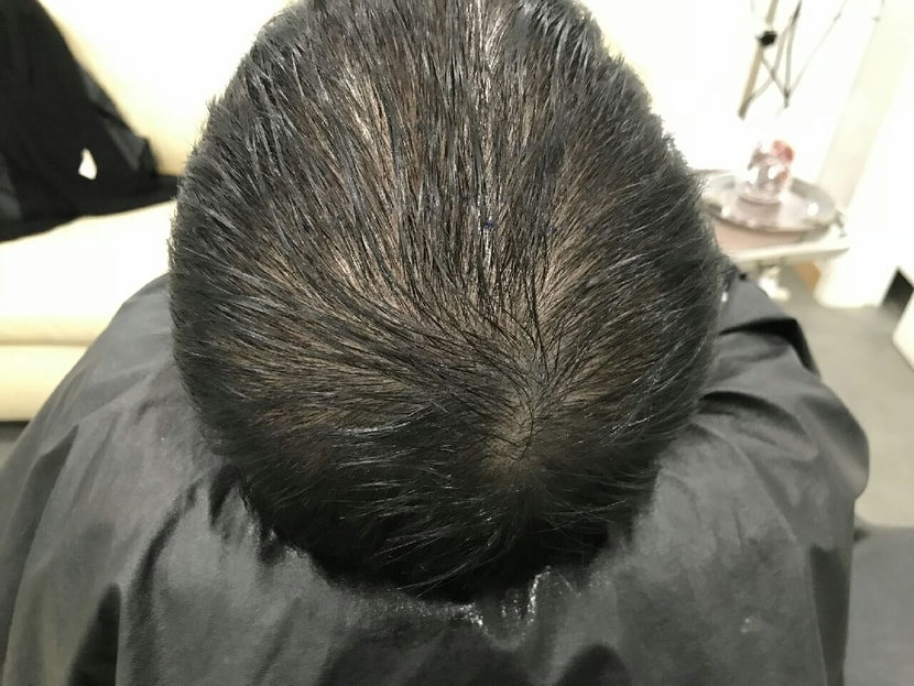 시술전입니다