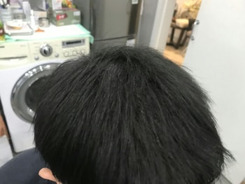 여기도 시술후 사진 