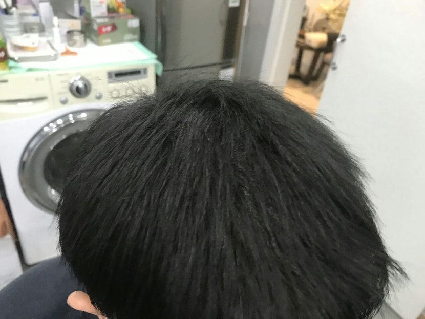 여기도 시술후 사진 