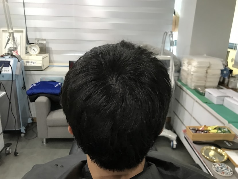 ##시술 후##
