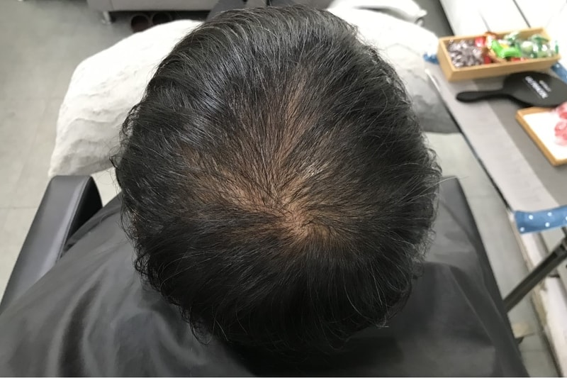 [延世美达人] 头皮纹身后记
