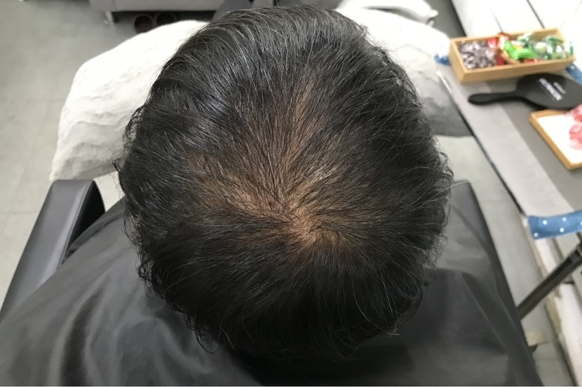 1년전 두피문신 전 