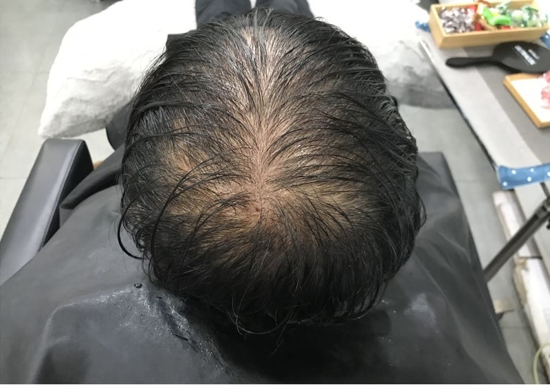 [延世美达人] 头皮纹身后记