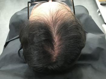 시술전