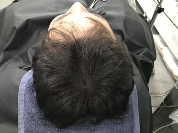 시술후