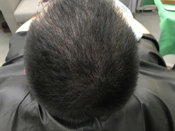 시술 후2