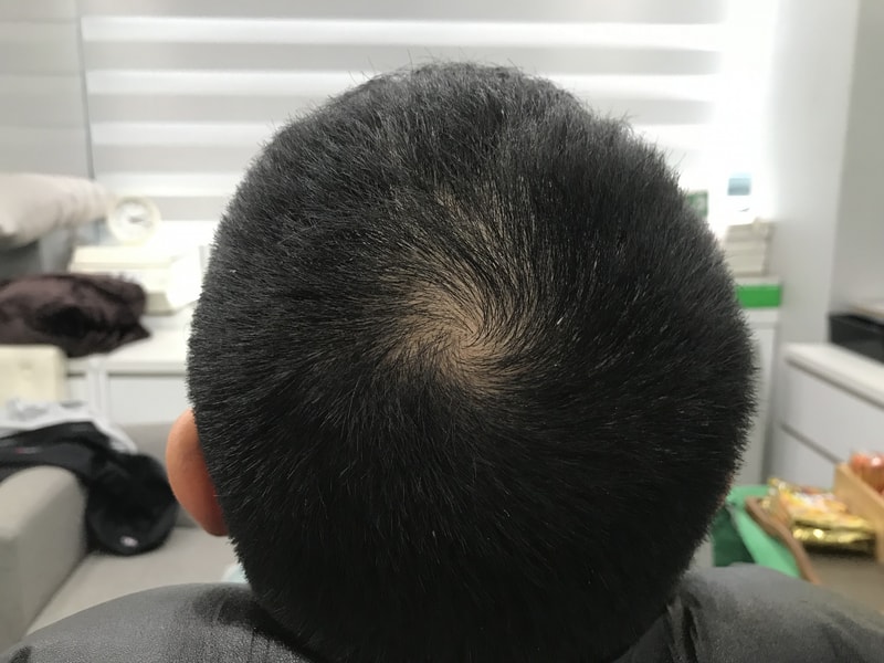 我去纹了头皮。