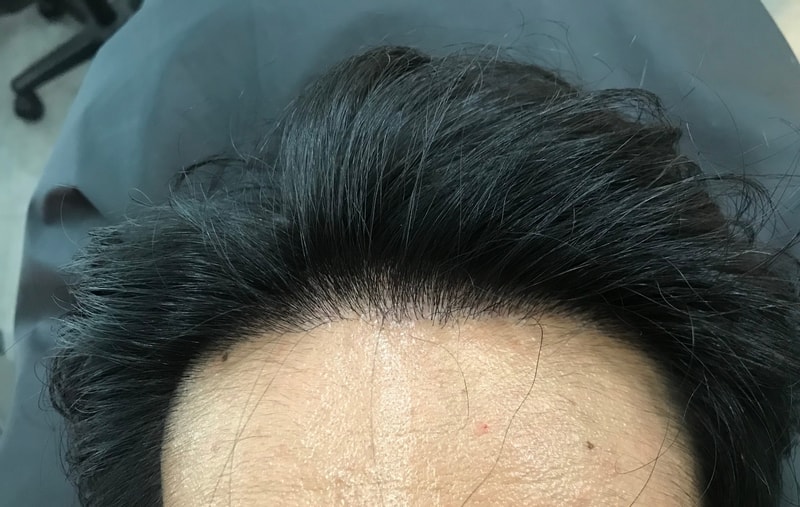 发际线头皮纹身第一次后期