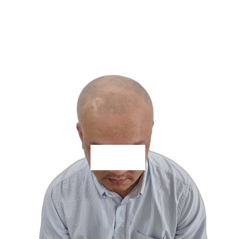 긴 고민 끝에 두피문신 했습니다