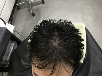 시술후