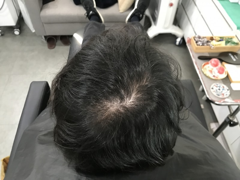 頭皮のタトゥー1次レビューです