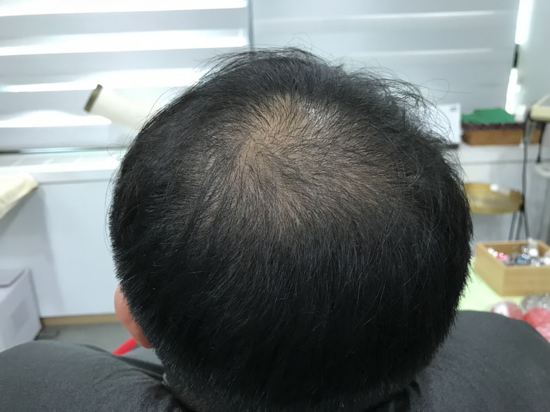 [연세미다인]두피문신 후기올립니당