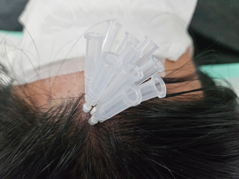 延世ミダインで頭皮を刺しました~