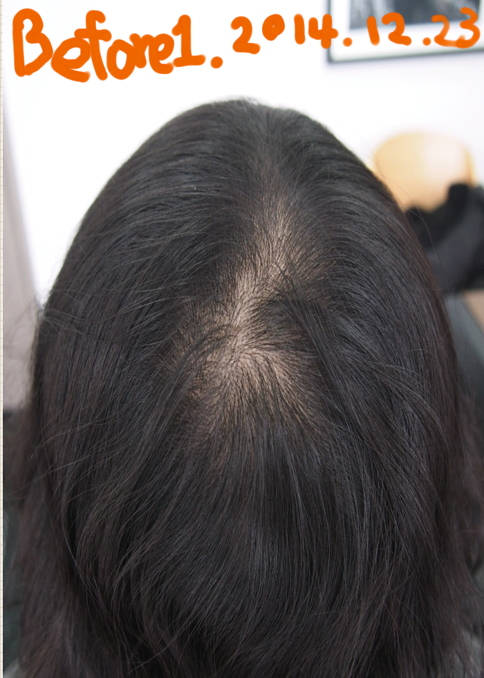 It's been a week since I got my scalp tattoo : )*