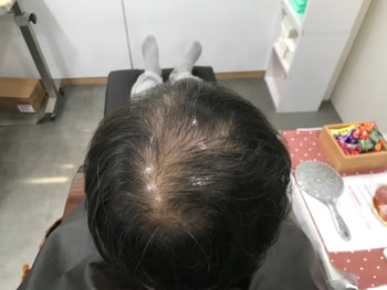 시술전 