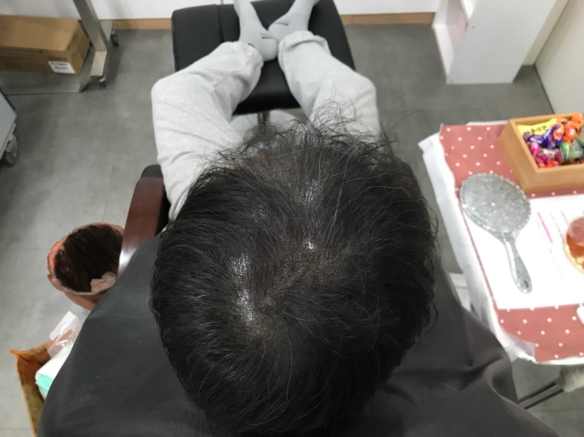 시술후