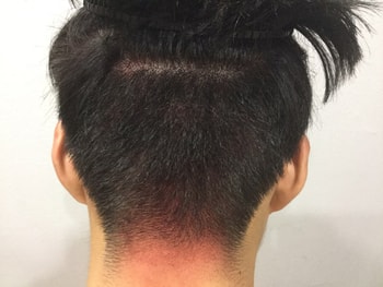 후두부 흉터 시술후