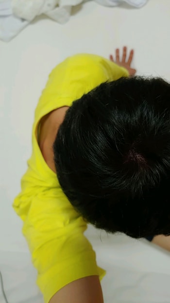 정수리 시술후