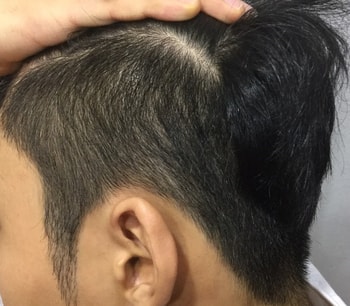 구렛나룻 옆라인 시술전