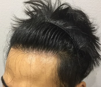 이마 이식부위 시술전